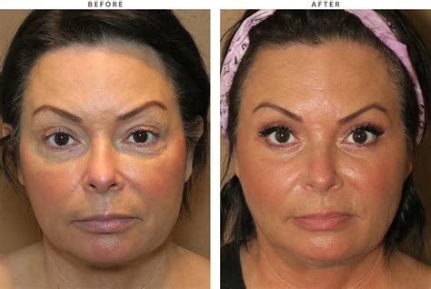 Mid Face Lift – Before and After Pictures * | Dr Turowski - Plastic ...