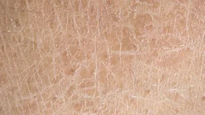 difference  dry skin  dehydrated skin