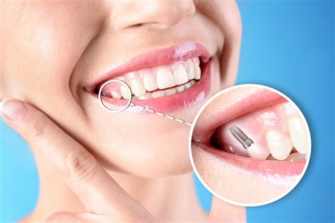 Dental Durability: What Makes Implants Successful? — Seahurst Smiles of
