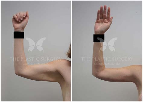 extended arm lift scar  jennifer colbert blog