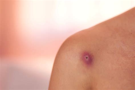 Como Fica O Furúnculo Depois Que Estoura - Furúnculo: sintomas, causas, tratamento e prevenção