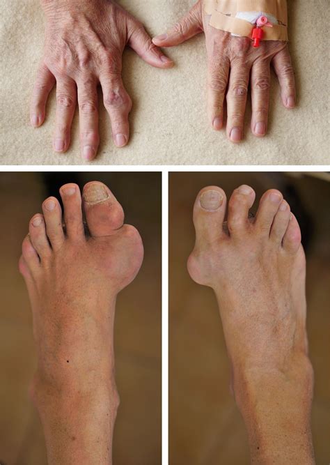 Rare Manifestation of Gout: Gouty Tophi in the Nose : Annals of Plastic