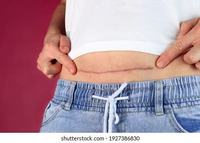 106 Hysterectomy scar Images, Stock Photos & Vectors | Shutterstock