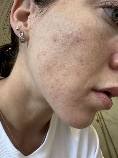 Hormonal acne : r/AusSkincare
