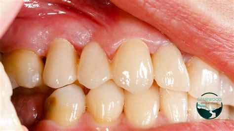 cavities explained      cavities