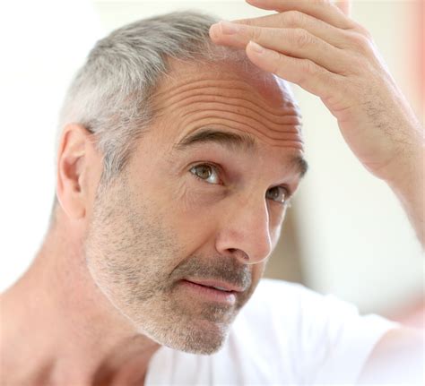 doctors explain the main biological causes of hair thinning at hairline male 11