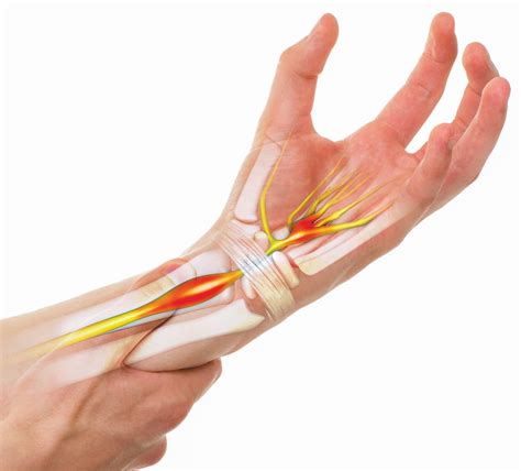 Understanding Carpal Tunnel Syndrome - Read this story on Magzter.com