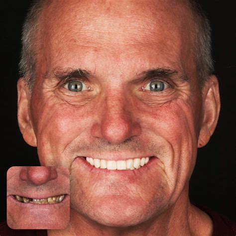 Full Mouth Dental Implants Dallas, TX | Doctors Implants