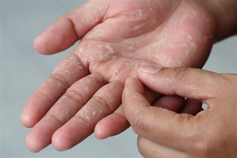 Mãos E Pés Descamando - Mãos descascando: causas, tratamentos e dicas para cuidar da pele