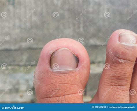 Dirty Toenails Can Cause a Foul Smell and Ingrown Toenails Stock Photo ...