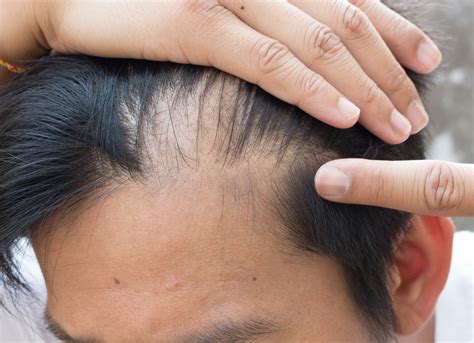 Hair Miniaturization: Understanding the Causes of Male Pattern Baldness