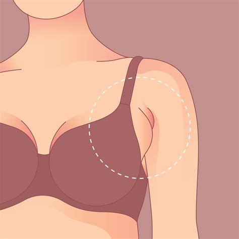 Armpit Fat Removal Melbourne at Lisa Hawke blog