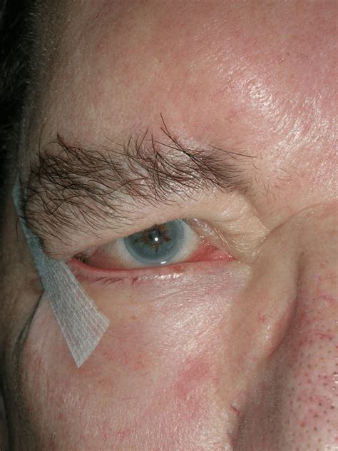 Ectropion Repair (Outwards Turned Eyelid) - Benoe