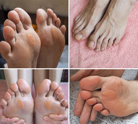 Let’s Look at Foot Bumps: Corns, Calluses and Bunions - Foot Health