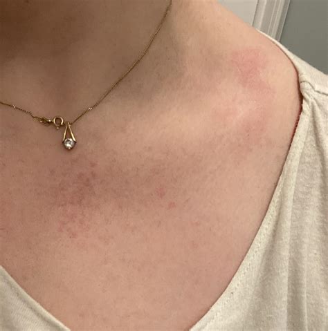 Random red splotches : r/medical_advice