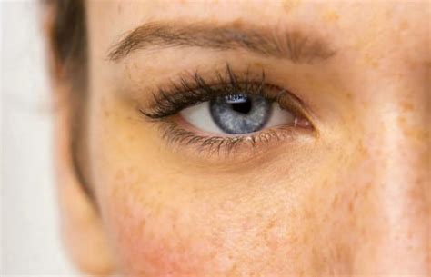 brown spots dermatology institute  laser center  nj