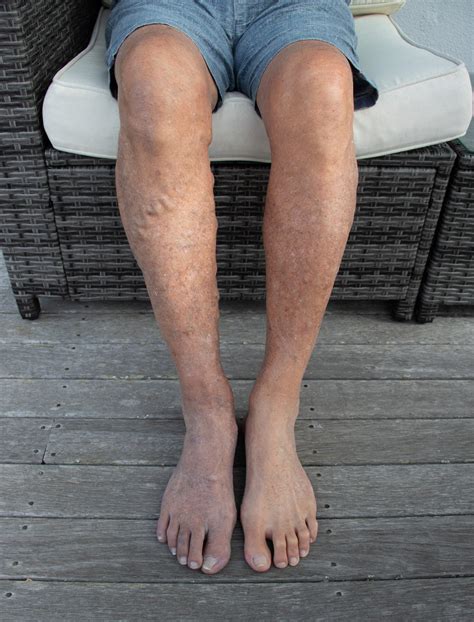 Circulation Issues in Legs: Causes, Symptoms, and Treatment - Wellness