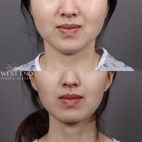 Liposuction & Buccal Fat Pad Removal Case 9367 - West End Plastic Surgery