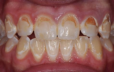 Temporary Tooth Filling Front Teeth : Dental Photos Before After Photos ...