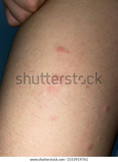 red rash   caused  stock photo  shutterstock