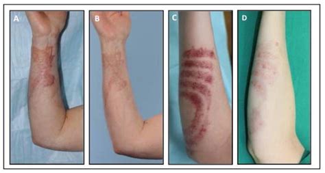 Scar Management of the Burned Hand - PMC