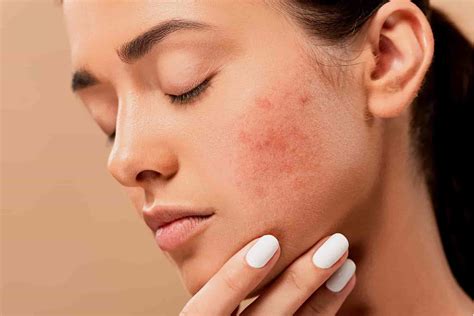 Why you can suffer more from pimples in winter - Health Bas