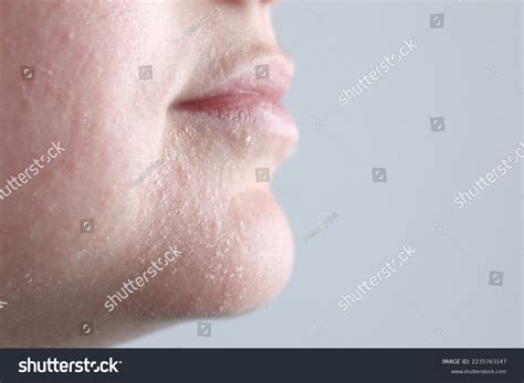 dry skin face royalty  images stock  pictures shutterstock