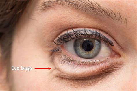Eyebag Removal Treatment In Manchester - My Cosmetic Clinic