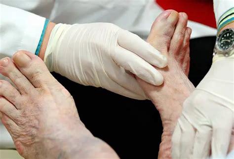 how to amputate a toe at home