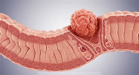 Tive Rompimento Do Intestino - Tumores do Intestino Delgado: Guia Completo sobre Tipos, Riscos e ...