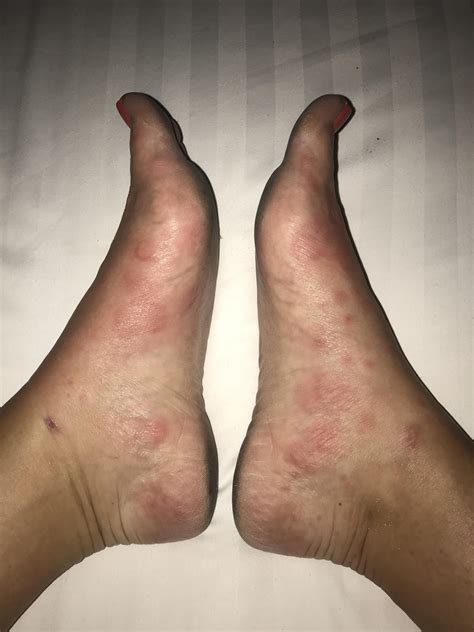Top Foot Hives On Feet Flash Sales | emergencydentistry.com