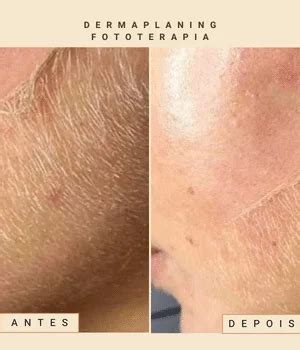Fototerapia Antes E Depois
