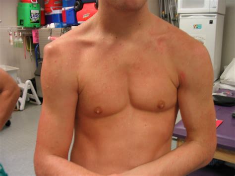 Dislocated Shoulder Cast