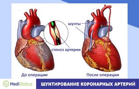 Стоимость шунтирования сердца за рубежом | Medical Tourism with ...