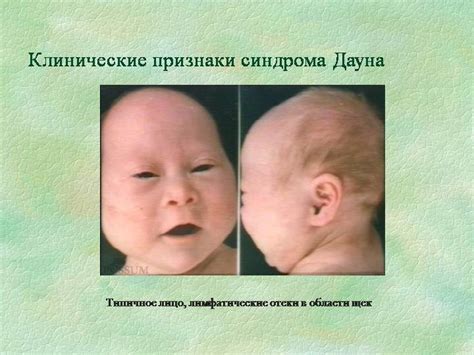 Синдром нунан фото детей