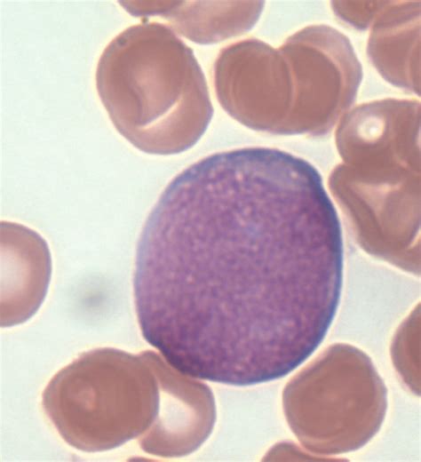 Leukocytosis - Cancer Therapy Advisor
