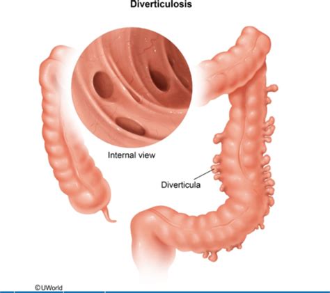 diverticulois diverticular disease diverticula flashcards quizlet