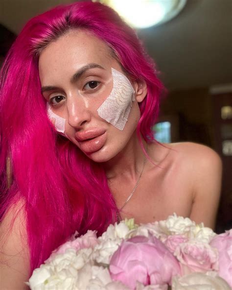 La femme aux plus grosses joues du monde prévoit de subir encore plus d