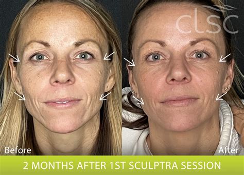 Sculptra - Before & After | Columbia Laser Skin Center