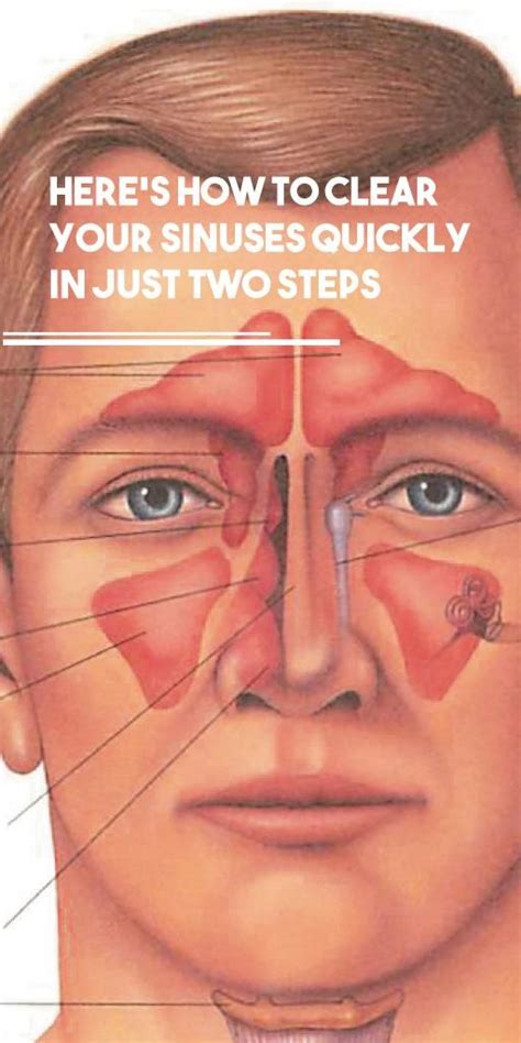 heres   clear  sinuses quickly    steps sinusitis