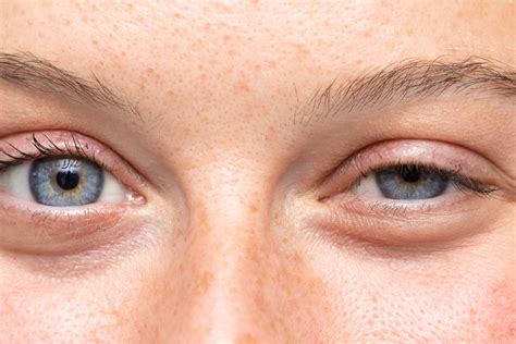 Painful Bump on Eyelid: Causes & Treatment | MyVision.org