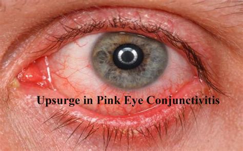 upsurge  pink eye conjunctivitis