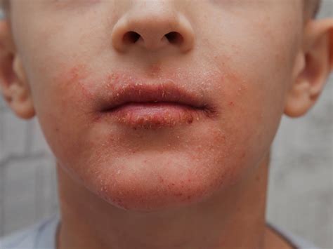 perioral dermatitis balmonds