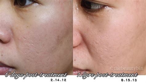 Fractional CO2 Laser for Acne Scars - Results, Photos, and the Rough Conclusion | The Beauty Bin