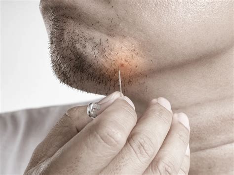 Is Laser Hair Removal An Effective Ingrown Hair Treatment? – Creative Touch