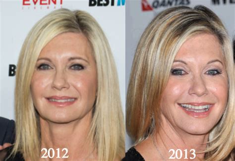 Olivia Newton-John Plastic Surgery Before and After Photos - Latest Plastic Surgery Gossip And ...