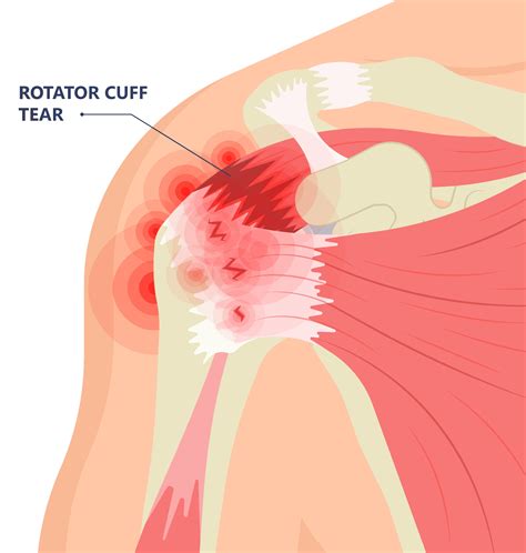Rotator Cuff Tear? Here's What You Need To Know! Dr. McClintock [Video]