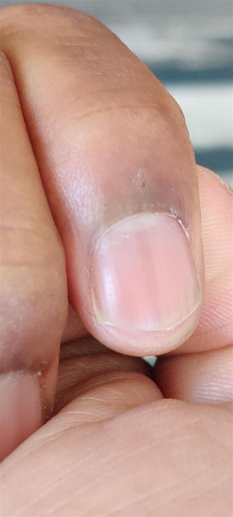 Is this longitudinal melanonychia? : r/DermatologyQuestions