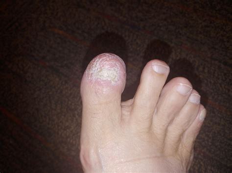 What does a toe nail look like after its been permanently removed? (my