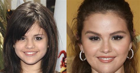 Selena Gomez: Plastic Surgery or Lupus? Why Fans are Wrong